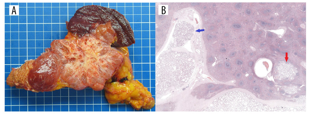 (A) Large lobulated mass of the pancreatic tail with a central calcified scar invading the splenic hilum. (B) Serous cystadenoma invading the splenic parenchyma on the right and the splenic vein on the left. Red arrow: splenic parenchyma invasion, blue arrow: splenic vein invasion. Magnification: 10×; H&E.