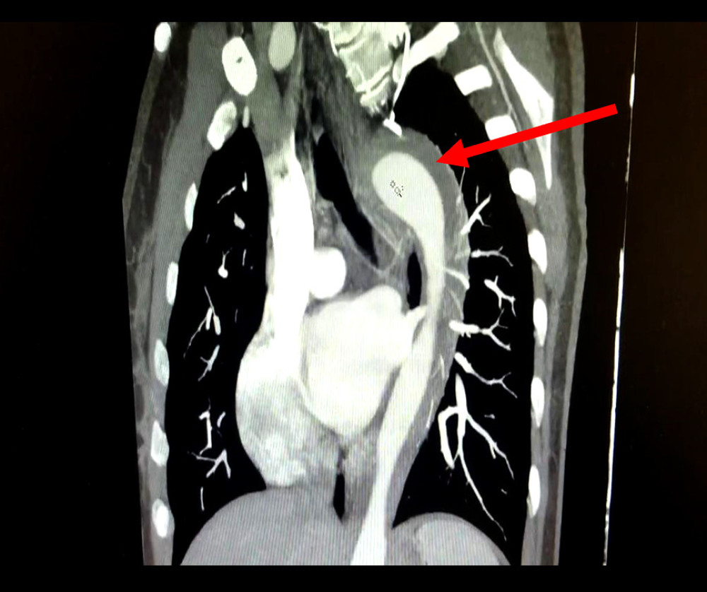 Sagittal view contrast-enhanced computed tomography scan of the chest showing intramural hematoma of the descending thoracic aorta extending from the left subclavian to the aortic hiatus of the diaphragm.