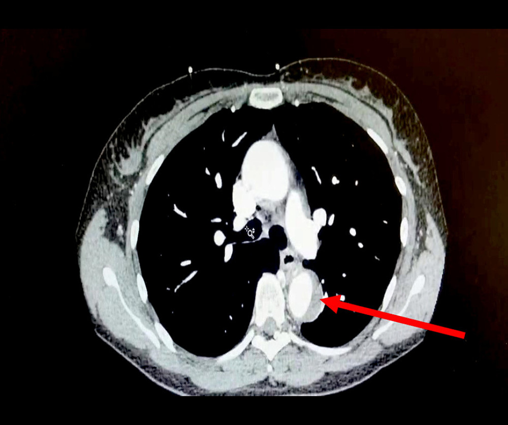 Transverse view of contrast-enhanced computed tomography scan of the chest showing intramural hematoma of the descending aorta.