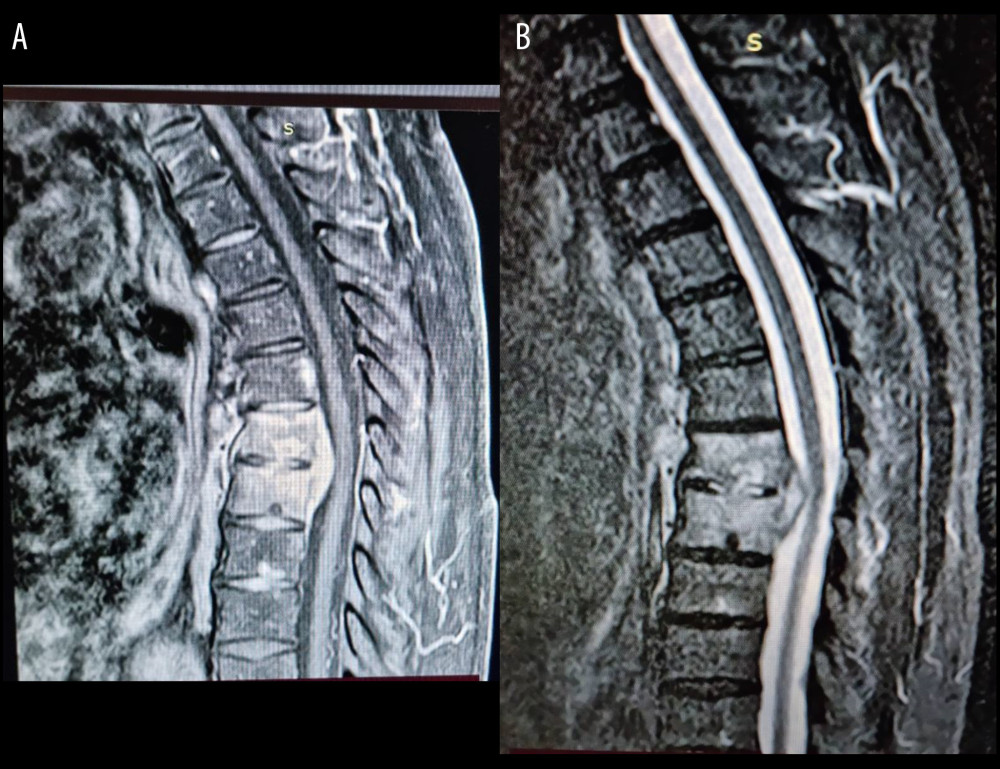 (A, B) MRI of the thoracic spine showed septic spondylodiscitis in the T6–T7 level with associated osteomyelitis in the T6 and T7 vertebra, as well as a mass like lesion in the anterior epidural space representing an epidural abscess. MRI – magnetic resonance imaging; T – thoracic.