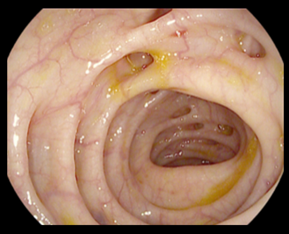 Multiple diverticula were found, both in the left and right colon, during colonoscopy.
