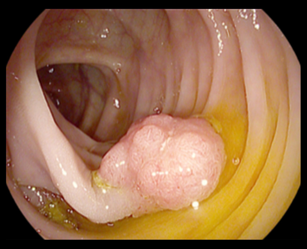 A 1.5-cm tubulovillous adenomatous polyp was also found and was completely excised.