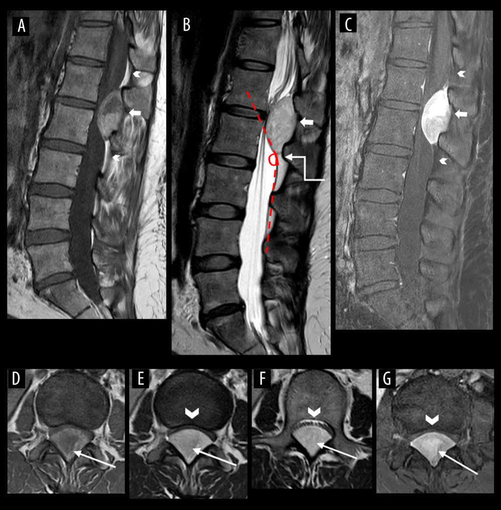 Magnetic resonance imaging (MRI) of a 38-year-old woman with spinal capillary hemangioma. (A) Sagittal T1-weighted (w) non-contrast image shows a well-defined T1 iso- and hyperintensity lesion relative to the spinal cord at the L1–L2 level (arrow). The tumor effaces the posterior epidural fat (arrowheads). (B) Sagittal T2w image shows a hyperintense extradural tumor (arrow) forming an obtuse angle (red-dotted lines and elbow connector arrow) with adjacent CSF. As the extradural tumor is covered anteriorly by an overlying dura, it gives the appearance of “marble under the carpet” where the marble represents the tumor (arrow) and the carpet resembles the dura mater. (C) Sagittal T1w fat-saturated post-contrast image reveals a well-defined and avid enhancing extradural tumor (arrow) displacing cauda equina nerve roots anteriorly within the spinal canal. The tumor effaces the posterior epidural fat without involving the posterior elements of the vertebrae (arrowheads). (D) Axial T1w pre-contrast image shows the extradural tumor (arrow) symmetrically displacing and indenting dura and cauda equina anteriorly. (E, F) Axial T2w images demonstrate the T2 hyperintense tumor (arrows) causing anterior displacement of the cauda equina nerve roots (arrowhead) within the spinal canal. The intraspinal nerve roots are arranged in a curvilinear fashion, surrounded by a thin rim of CSF at L1–2 level (arrowheads). (G) Axial T1w fat-saturated and post-contrast image shows the well-defined and avid enhancing extradural lesion (arrow) measuring approximately 1.1×2.0×5.0 cm (anteroposterior x transverse x craniocaudal) in size. It displaces the cauda equina nerve roots anteriorly within the spinal canal. The intraspinal nerve roots are arranged in a curvilinear fashion, surrounded by a thin rim of CSF at L1–2 level (arrowhead).