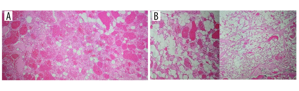 (A) Lower magnification photomicrograph showing numerous small and thin-walled capillaries lined by single-layered bland endothelia separated by mature adipose tissue. There is no evidence of cytologic atypia [Hematoxylin and eosin (H&E) stain magnification, ×10]. Histological findings are compatible with a capillary hemangioma with fatty involution. (B) Higher magnification photomicrograph showing again numerous thin-walled capillaries lined by single-layered bland endothelia with fatty involution. No evidence of cytologic atypia is detected (H&E stain, magnification, ×20). Histological findings are compatible with a capillary hemangioma with fatty involution.