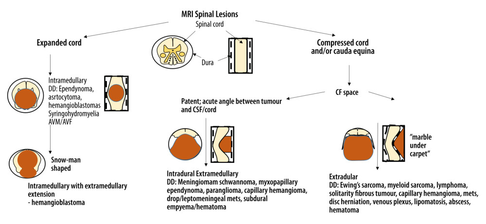 Schematic diagram of the spinal MRI (created using Microsoft PowerPoint drawing function) illustrated the various spinal lesions distributed in different compartments within the spine. Intramedullary lesions are often associated with spinal cord expansion, while extramedullary lesions narrow the calibre of the spinal cord. Extramedullary lesions are further divided into those commonly found in the intradural extramedullary and extradural compartments by virtue of the state of the surrounding CSF and the angle between the lesions and cord/CSF space. Intradural extramedullary lesion compresses the spinal cord and forms an acute angle with the cord and gives the appearance of a “marble above the carpet”; the marble represents the tumor/lesion and the carpet resembles the dura mater. Besides, the CSF space is relatively preserved and there is a smooth interface between the cord and the tumor. Extradural lesions often efface the surrounding CSF space and form an obtuse angle with the CSF on sagittal T2w image. It gives the appearance of a “marble under the carpet”. AVM – arteriovenous malformation; AVF – arteriovenous fistula; CSF – cerebrospinal fluid; mets – metastases
