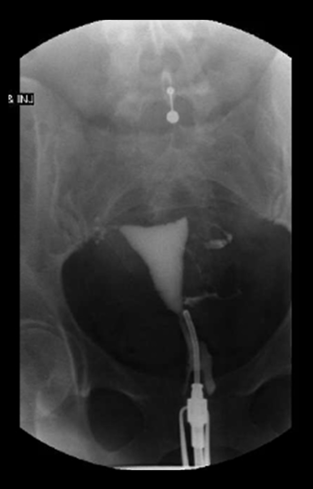 Hysterosalpingogram prior to pregnancy. Hysterosalpingogram image showing a filling defect at the site of prior right salpingectomy, and left tubal patency.