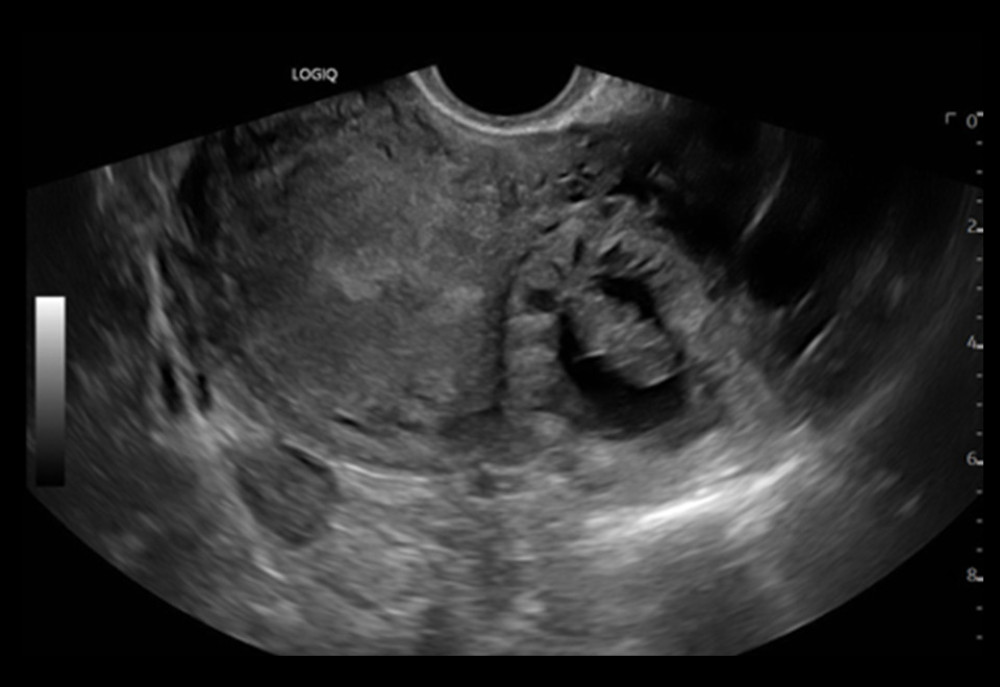 Ultrasound of interstitial ectopic pregnancy measuring 9 weeks. Ultrasound imaging depicting a 9-week gestation within the left lateral myometrium of the uterus.