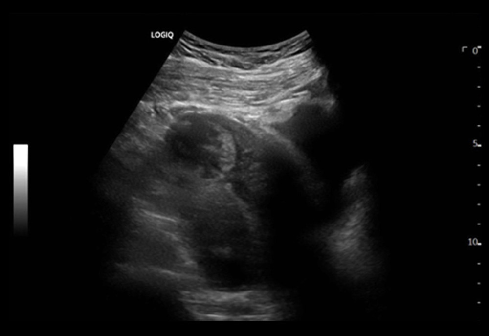 Ultrasound of pregnancy without intrauterine implantation. Ultrasound imaging demonstrates a gestational sac within the tubal interstitium, and the endometrial lining of the cavity is non-contiguous, with decidual reaction surrounding the pregnancy.