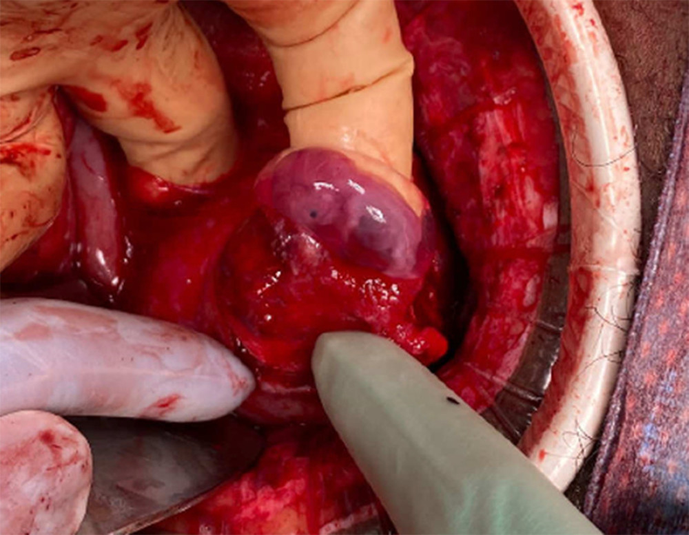 Pregnancy delivered through uterine serosa. The pregnancy was superficial to the overlying serosa and gestational sac, with embryonic contents delivered en caul following serosal incision.