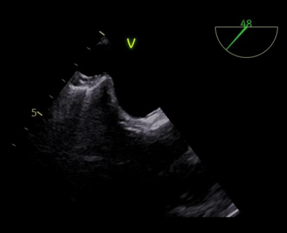 Transesophageal echocardiography just before transseptal puncture. This image shows tenting of the interatrial septum during guidance of transseptal puncture.