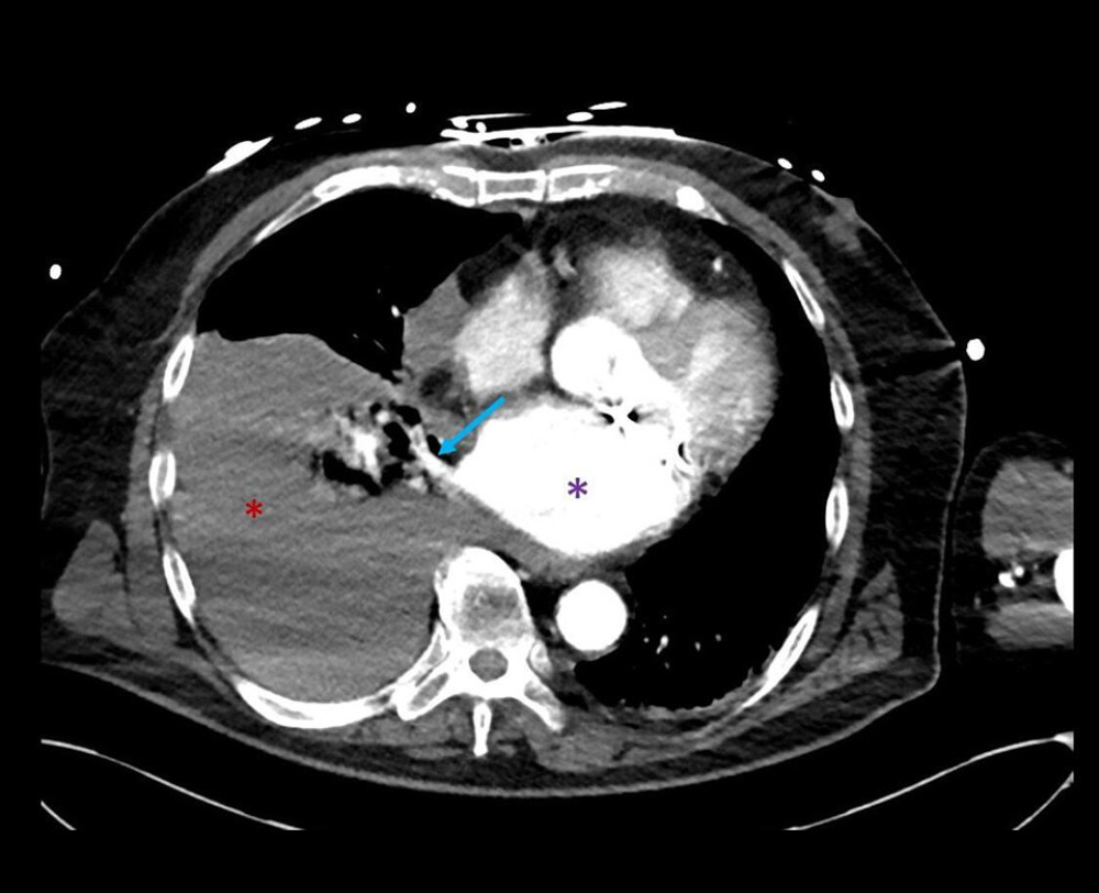 CT angiography. CT demonstrates massive pleural effusion on the right side (red asterisk), the right inferior pulmonary vein (blue arrow), and the left atrium (purple asterisk). Note absence of contrast blush, but presence of blood against the posterior side of the right inferior pulmonary vein and of the left atrium.