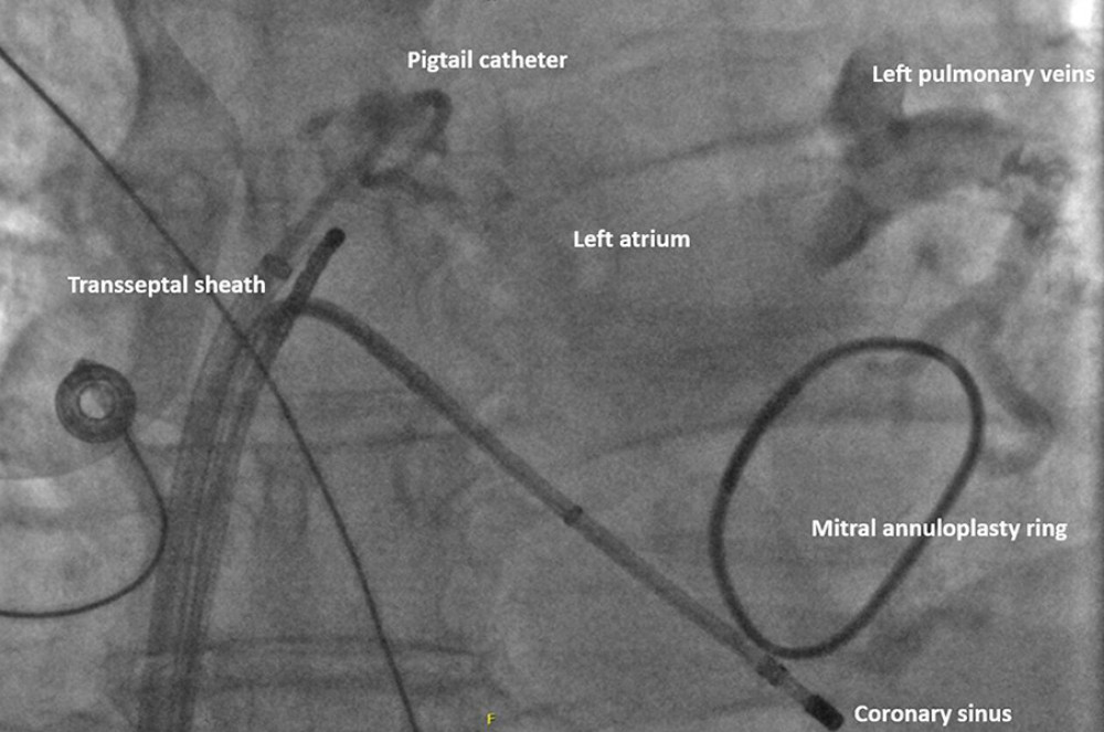 Fluoroscopic projection with left atrial angiogram after transseptal puncture. Note the proximity of the pigtail catheter to the right pulmonary veins.