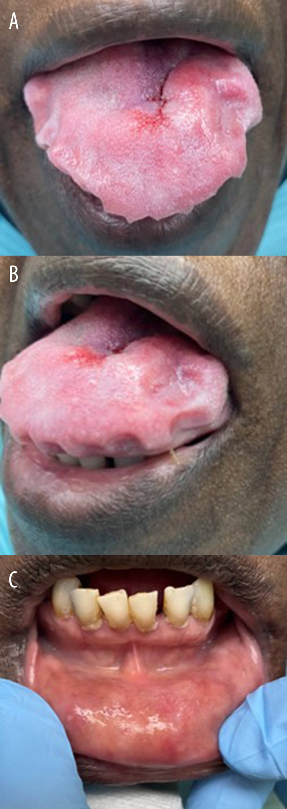 Clinical images of the tongue showing normal covering mucosa with macroglossia almost filling the oral cavity with dental indentation (A, B); and mandibular labial mucosa with normal covering epithelium and raised-thick surface due to amyloid deposition (C).
