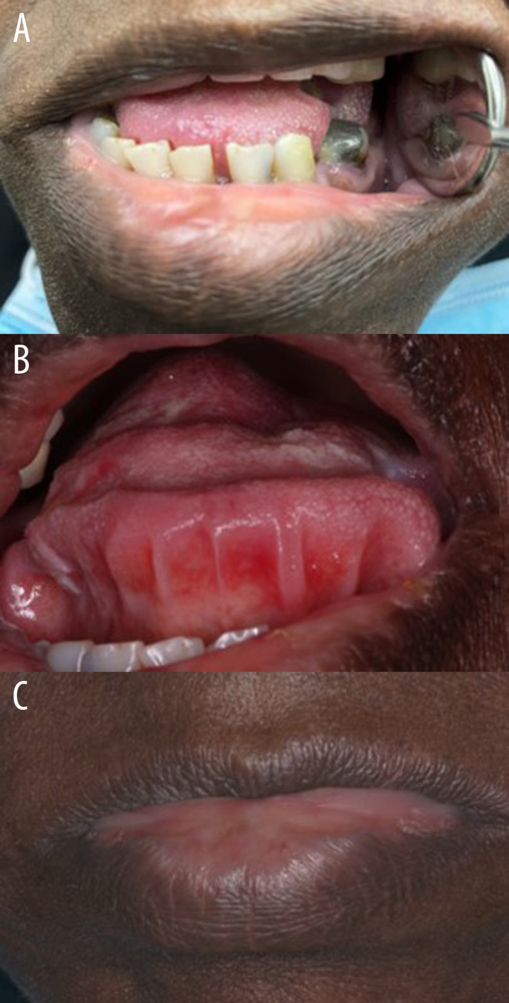 Clinical images of the tongue after 6 months of intralesional triamcinolone injections, showing reduced tongue size (A) and wider oral cavity space in which the palate can be seen (B) as well as the less prominent lower lip (C).