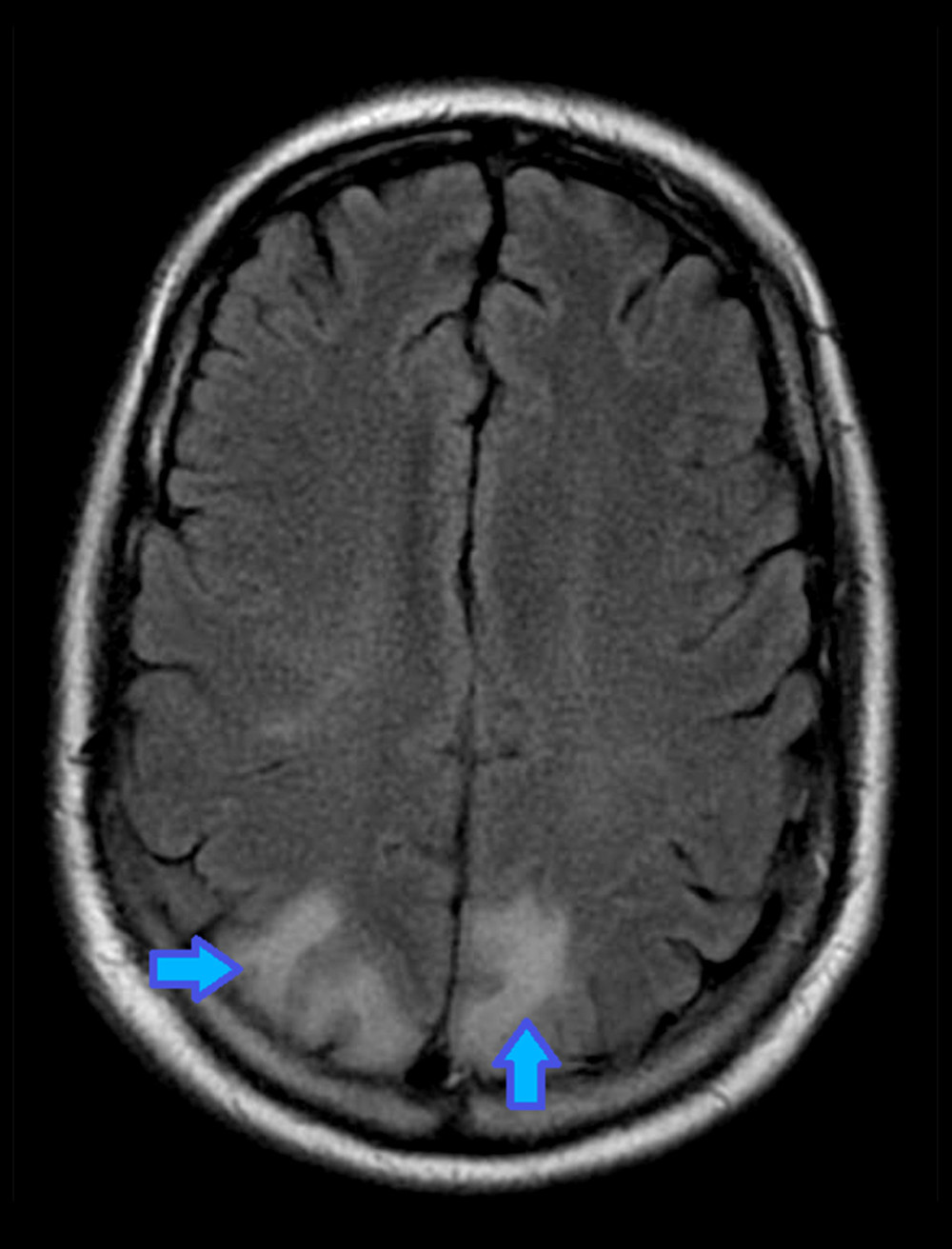 High T2/FLAIR signal intensities (blue arrows) in the regions of the parietal cortices.