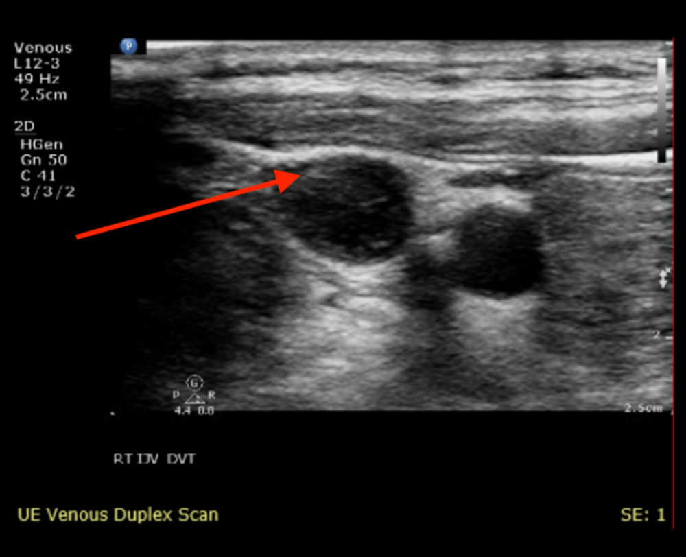 Right internal jugular, with compression. Arrow pointing to hyperechoic area in RIJ referring to clot in question.
