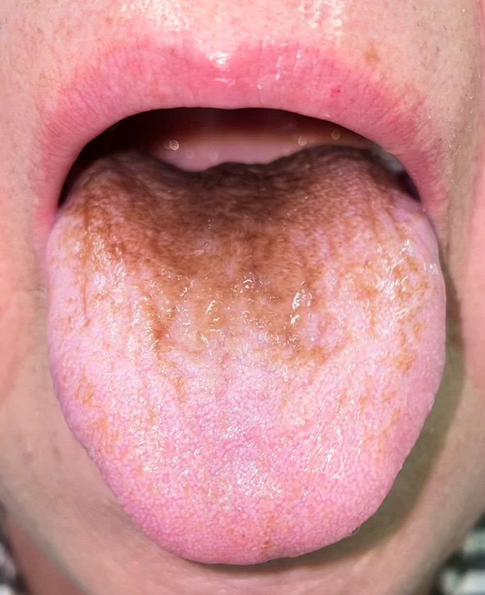 After starting moxifloxacin, the patient developed brown discoloration on the dorsum of the tongue with carpet-like elongated filiform lingual papillae.