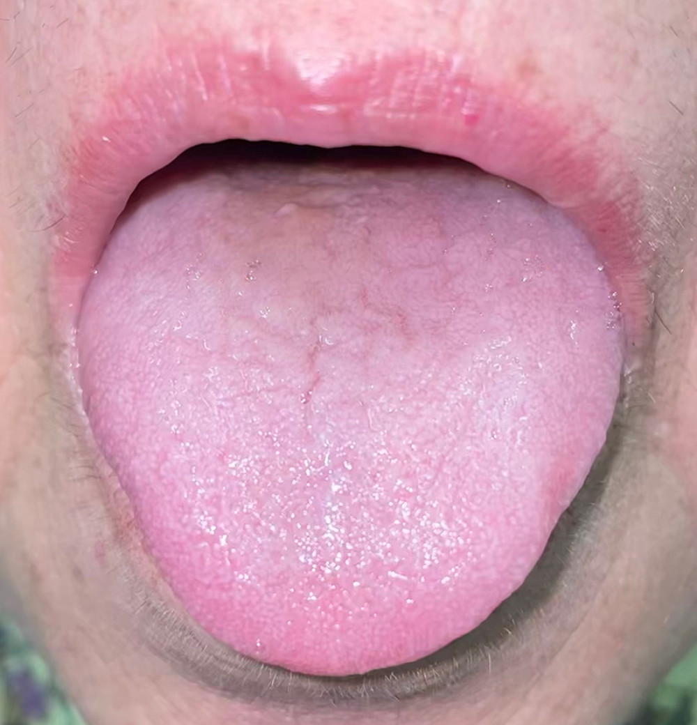 After stopping moxifloxacin, the black hairy tongue improved.
