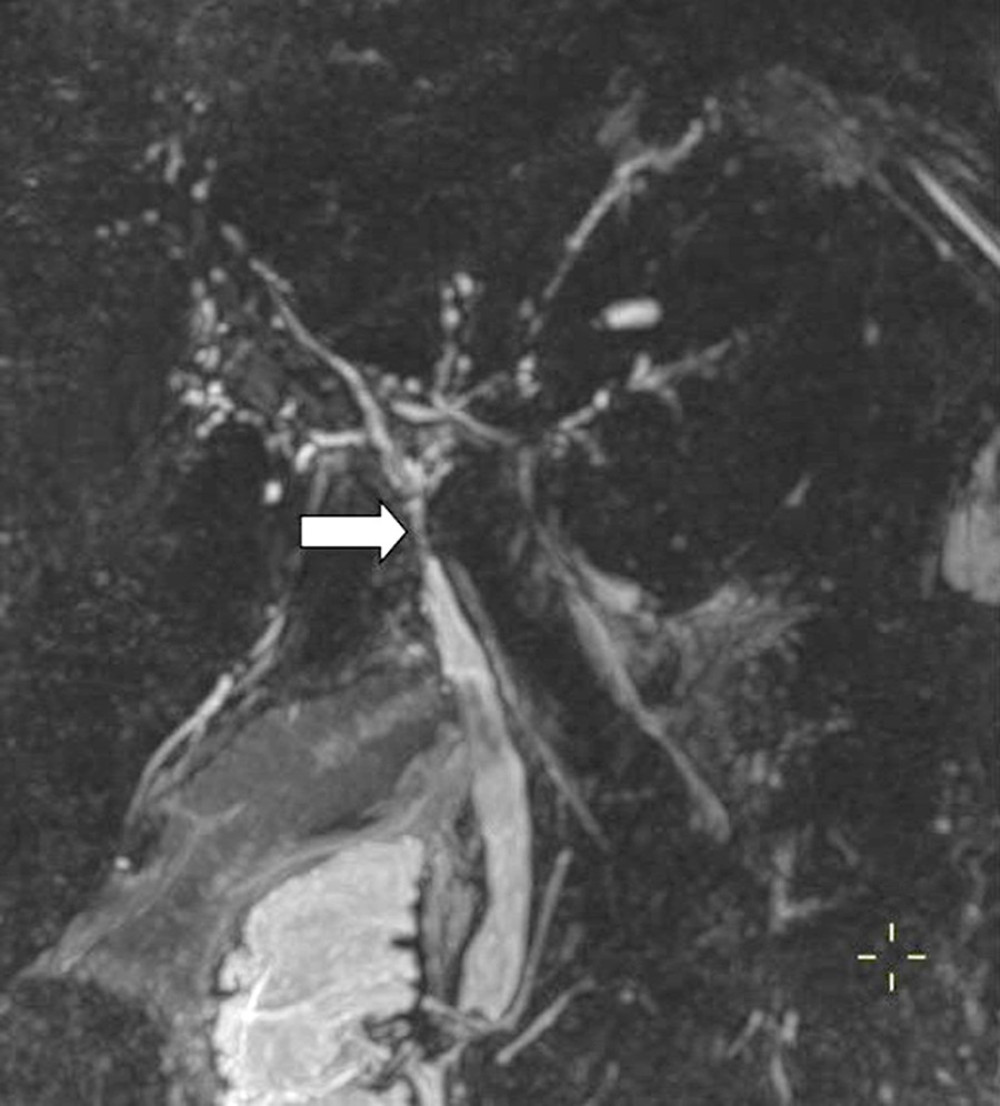 Magnetic resonance cholangiopancreatography image showing multiple strictures alternating with focal dilations of intra- and extrahepatic bile ducts (white arrow).