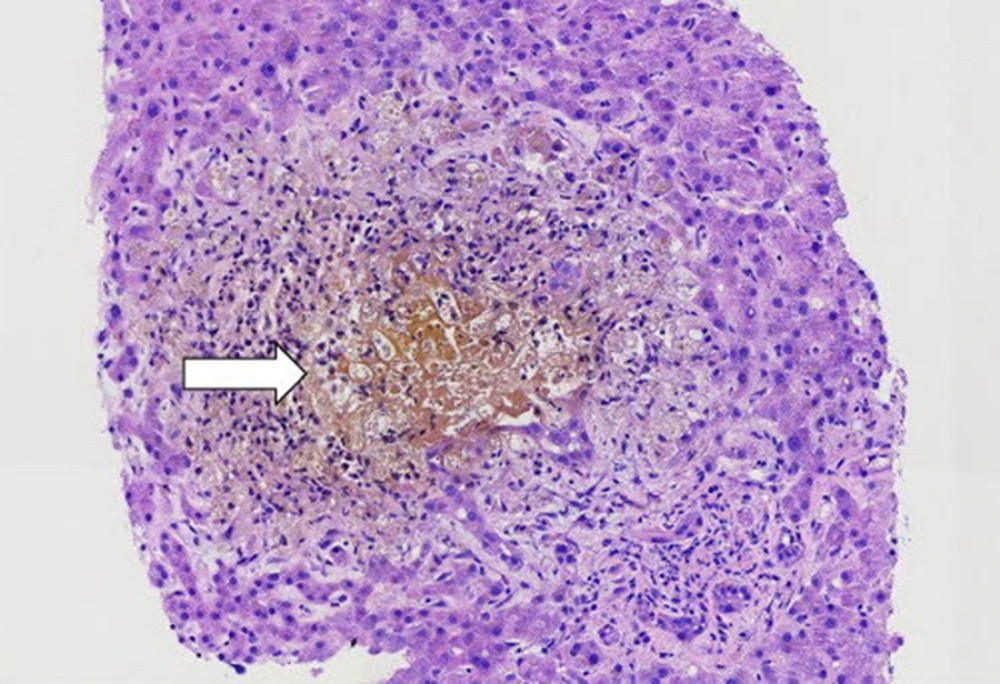 A bile infarct associated with ductular reaction and degenerative cholangiocyte injury (10×, white arrow).