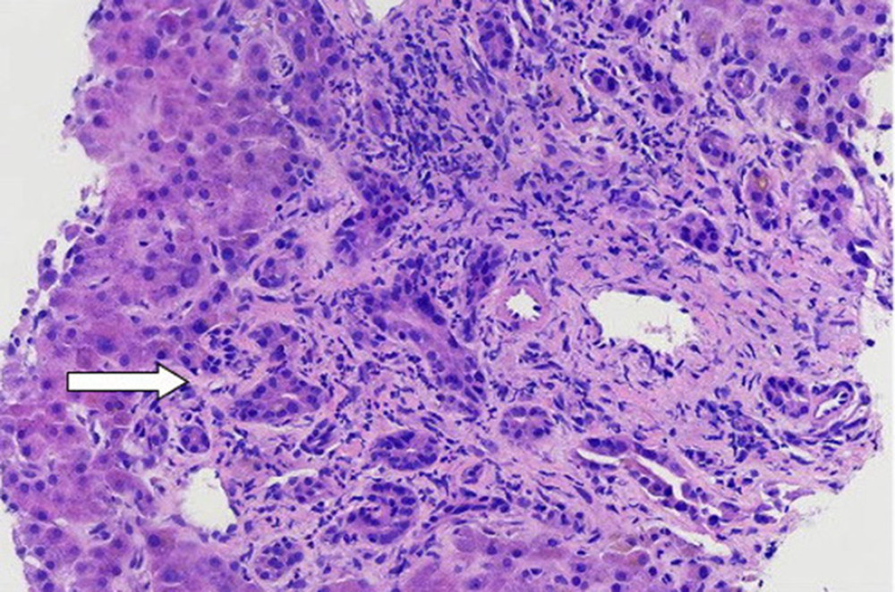 Bile ductular proliferation accompanied by neutrophils. Cholangiocyte cytoplasmic vacuolization injury (arrow, 40×).