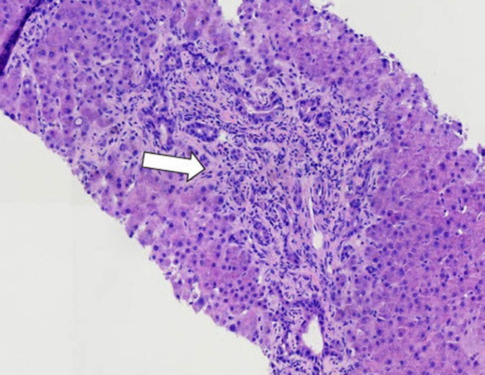 Portal fibrosis and bile ductular reaction – proliferation of small ductules at the periphery of the portal tract accompanied by neutrophils (10×, white arrow).
