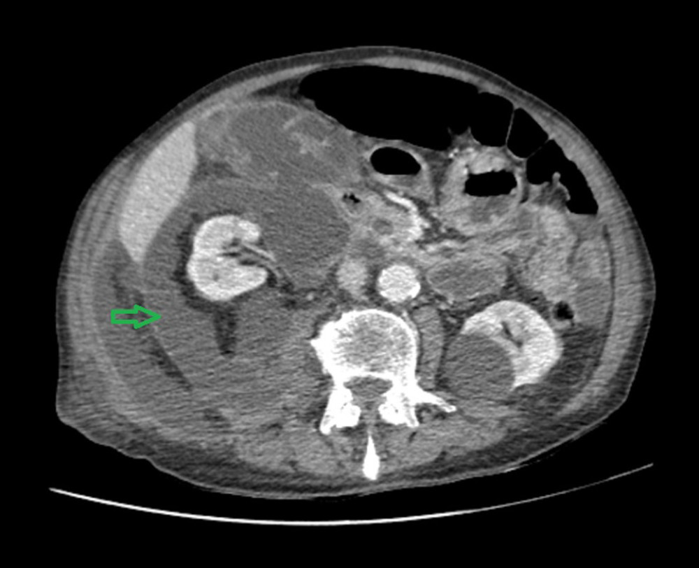 CT scan of the abdomen showing a retroperitoneal fluid collection. The arrow is demonstrating the fluid collection around the right kidney.