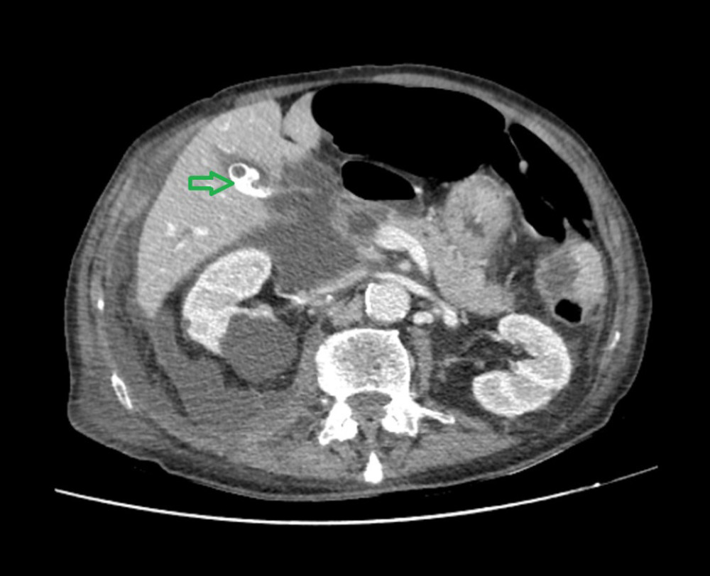 CT scan of the abdomen showing a retroperitoneal fluid collection, the gall bladder and the common bile duct. The arrow is demonstrating the gall bladder which is intact but with cholelithiasis.