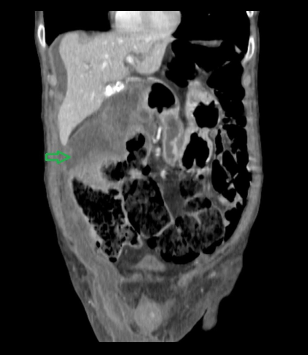 CT scan of the abdomen showing the extension of the retroperitoneal fluid collection. The arrow is demonstrating the collection which extends from the space dorsally to the duodenum and the head of the pancreas to the right inguinal region through Told’s and Gerota’s fascia, and right iliopsoas muscle.