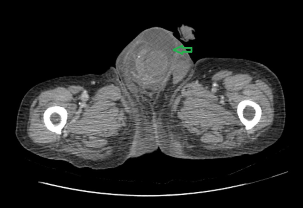 CT scan of the abdomen showing the extension of the retroperitoneal fluid collection in the right inguinal region and scrotum. The arrow is demonstrating the liquid which extends into the right inguinal canal where there were no omentum, mesenteric fat, or part of the bowel detected, and the scrotum.