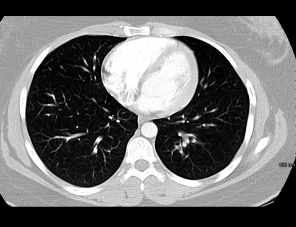CTA pulmonary.