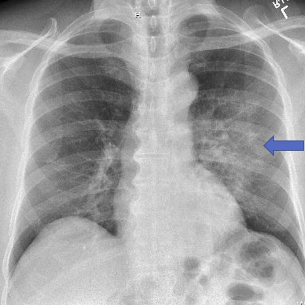 Chest X-ray on initial presentation. Hazy left perihilar opacities indicated a likely diagnosis of atypical baterial pneumonia.