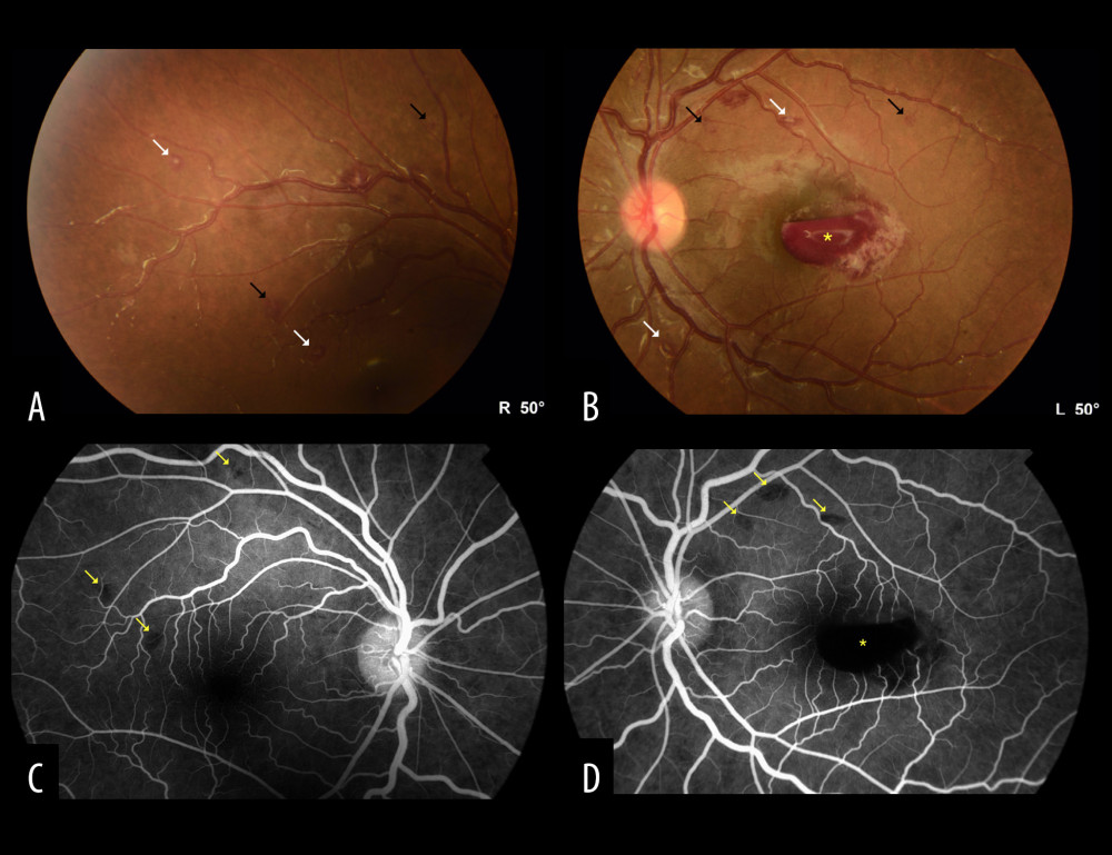 Color fundus photo of the right eye (A) and left eye (B) showing multiple intraretinal hemorrhages (black arrows) with few white-centered hemorrhages (Roth’s spots) (white arrows) involving the macula and posterior pole. Subhyaloid hemorrhage over the fovea in the left eye (yellow asterisk) (B). Fundus fluorescein angiography (FFA) of the right eye (C) and left eye (D) demonstrating hypofluorescent areas due to a blockage effect from intraretinal (yellow arrows) and subhyaloid hemorrhages (yellow asterisk).