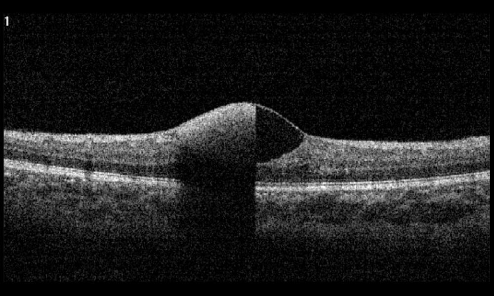 Spectral domain optical coherence tomography depicting dense hyperreflective materials (hemorrhage) under the internal limiting membrane (ILM), consistent with premacular subhyaloid hemorrhage.