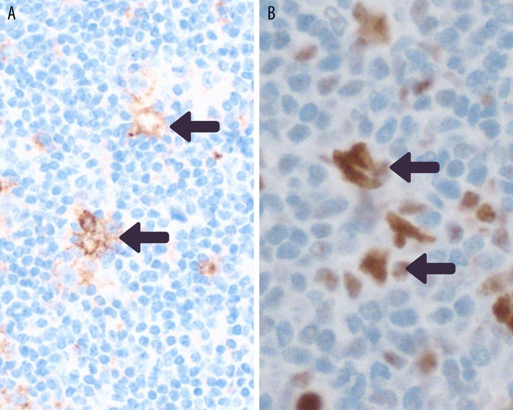 Photomicrographs of the immunostaining of the axillary lymph node for B cell lymphoma 6 (BCL6) protein and epithelial membrane antigen (EMA), which were consistent with a diagnosis of nodular lymphocyte-predominant Hodgkin lymphoma (NLPHL). (A) The expression of B cell lymphoma 6 (BCL6) protein. Magnification ×100. (B) The expression of EMA by the cell membrane of the scattered single lymphocyte-predominant (LP) cells (‘popcorn’ cells), which is characteristic of NLPHL. Magnification ×100.