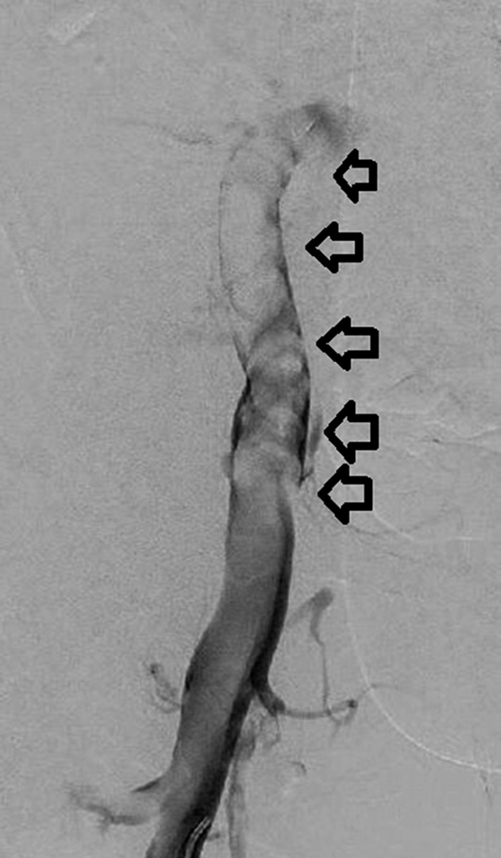 Left lower-extremity venogram with significant left femoral vein thrombus. Venogram performed via left popliteal vein access demonstrating the femoral vein. In this figure, flow is seen in the popliteal vein until reaching a significant amount of thrombosis identified in the femoral vein (black arrows), which impedes the flow of blood and contrast.
