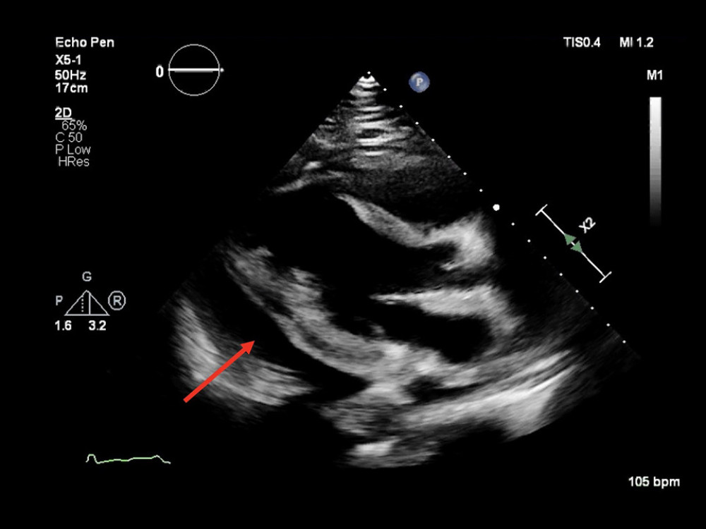 Transthoracic echocardiogram with arrow showing a large pericardial effusion.https://www.dropbox.com/s/hy48ji4yhxmavhw/936273_v01.mov?dl=0