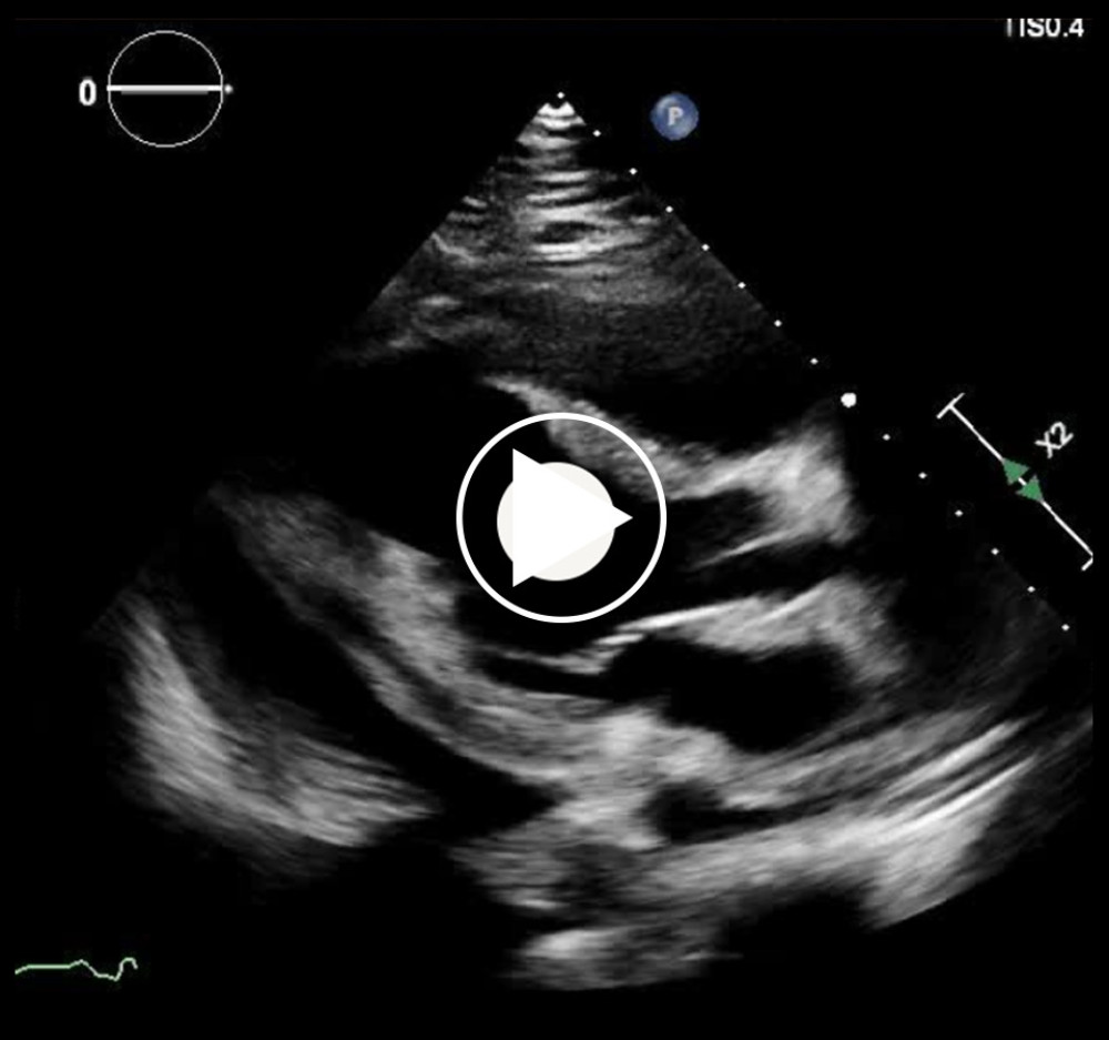 Transthoracic echocardiogram showing large pericardial effusion with right diastolic collapse and preserved ejection fraction.