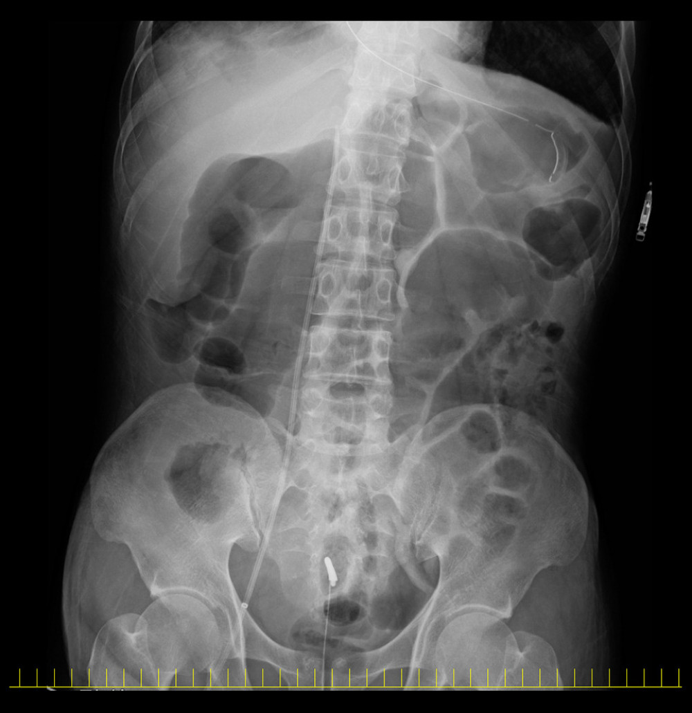 Abdominal radiograph following catheter placement through the right femoral vein. There were no findings that indicated catheter misplacement.
