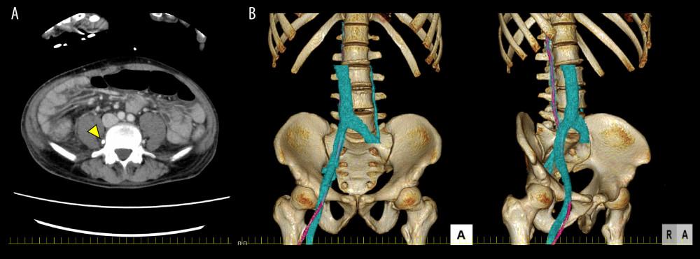 Abdominal computed tomography following catheter placement through the right femoral vein. (A) Contrast-enhanced computed tomography of the abdomen. The inserted catheter (yellow arrowhead) is placed into the right ascending lumbar vein. (B) Three-dimensional reconstruction of computed tomography showing the common iliac vein and inferior vena cava (blue) and an inserted catheter (magenta) misplaced into the right ascending lumber vein. In the frontal view, the catheter and inferior vena cava are overlapping.