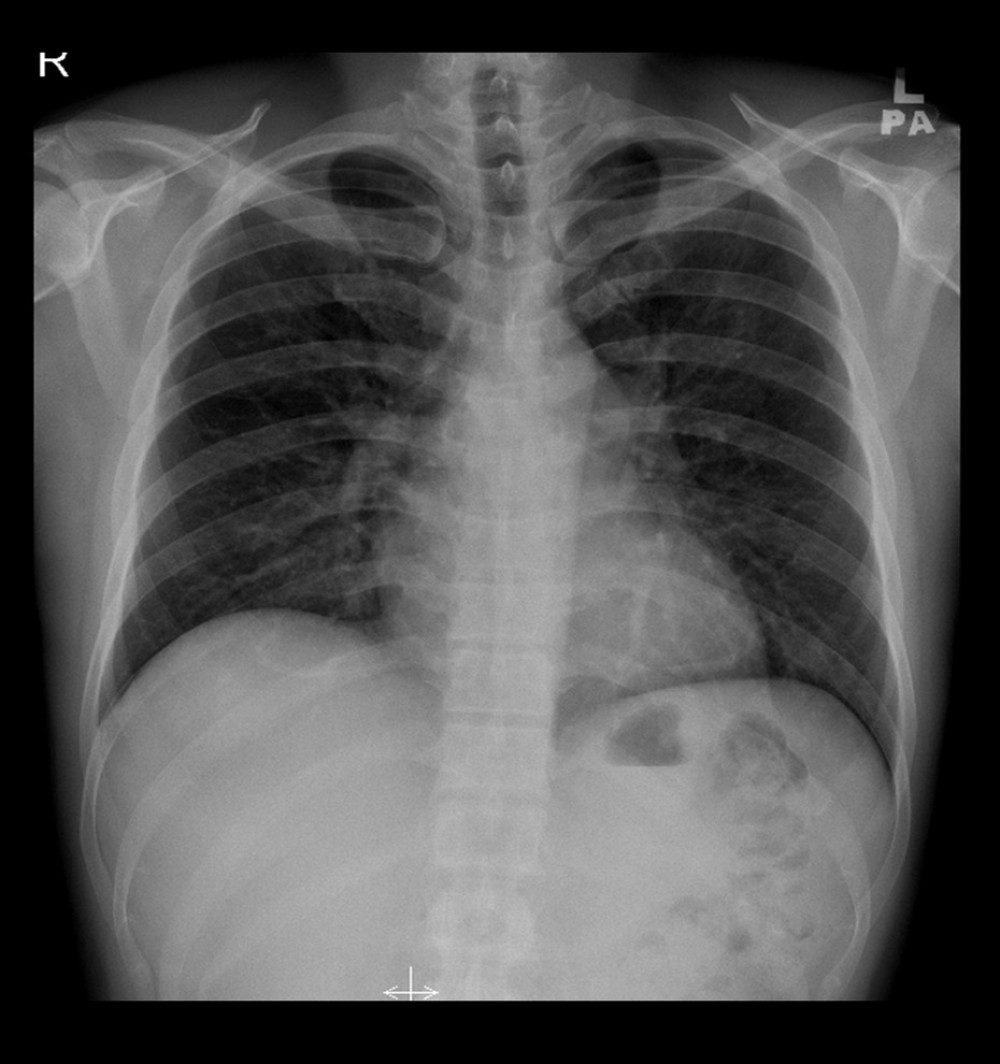 Chest X-Ray on June 30, 2020, showed clear lung fields with no mediastinal widening or hilar lesion.