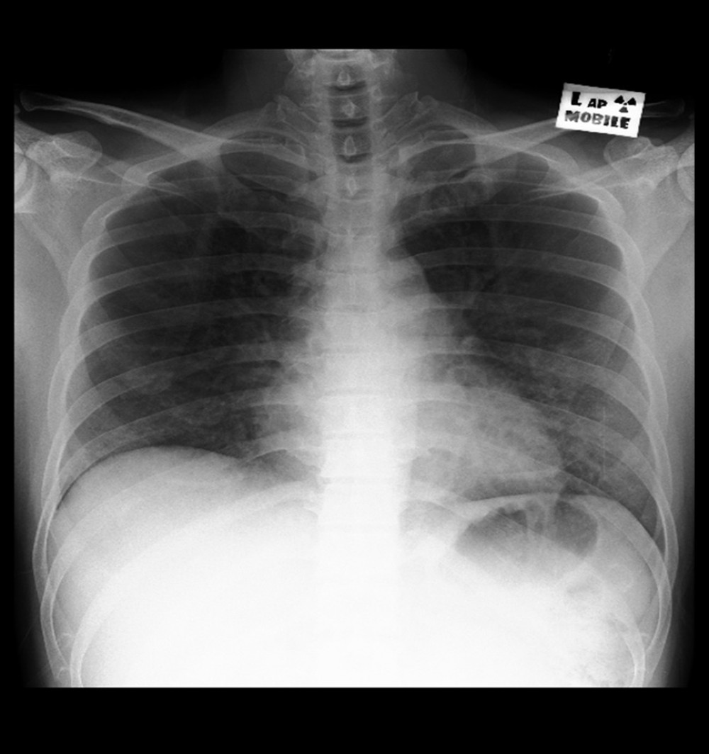Chest X-Ray on August 4, 2020, showed lung improvement after 4 weeks of treatment