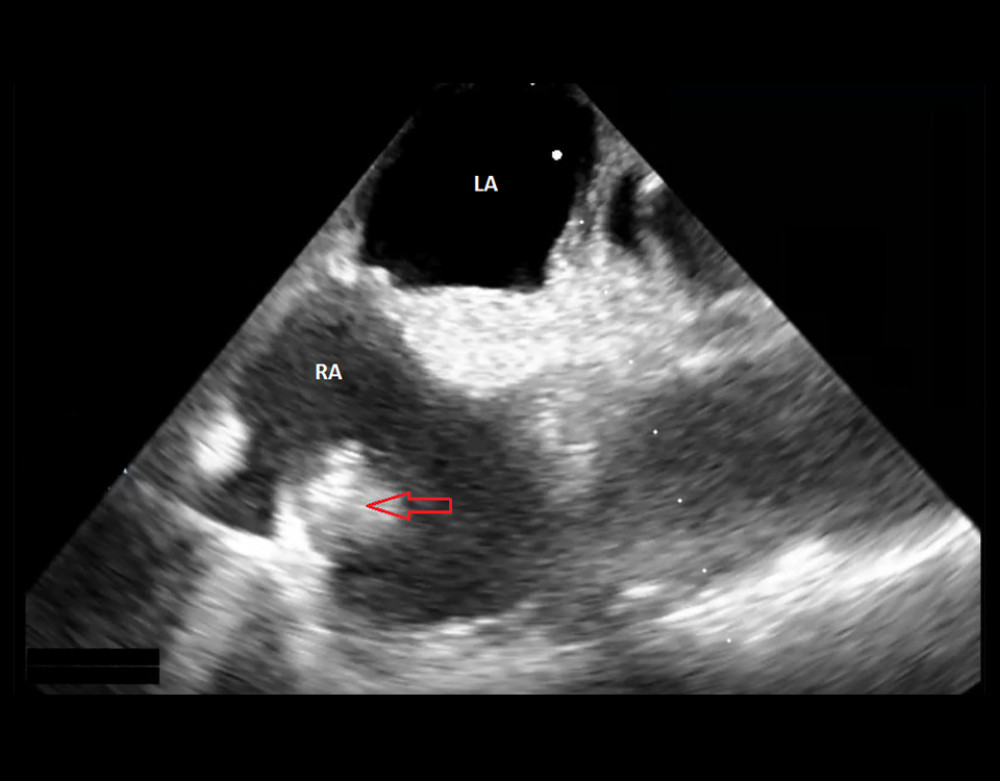 Related to Case 1: Two-Dimensional transesophageal echocardiogram showing Eustachian valvular vegetation. The red arrow clearly marks the vegetation on the eustachian valve itself. ‘RA’ refers to the right atrium and ‘LA’ refers to the left atrium in Figure 1.