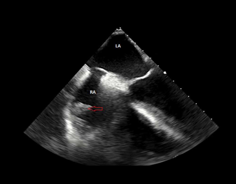 Related to Case 2: Two-Dimensional transesophageal echocardiogram showing eustachian valvular vegetation, which is distinctly indicated by the red arrow. Again, ‘RA’ stands for right atrium and ‘LA’ stands for left atrium in Figure 2.
