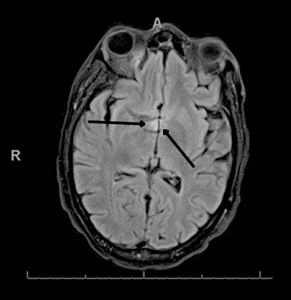 Magnetic resonance imaging of the brain with enhancement at the cervical medullary junction (arrows).