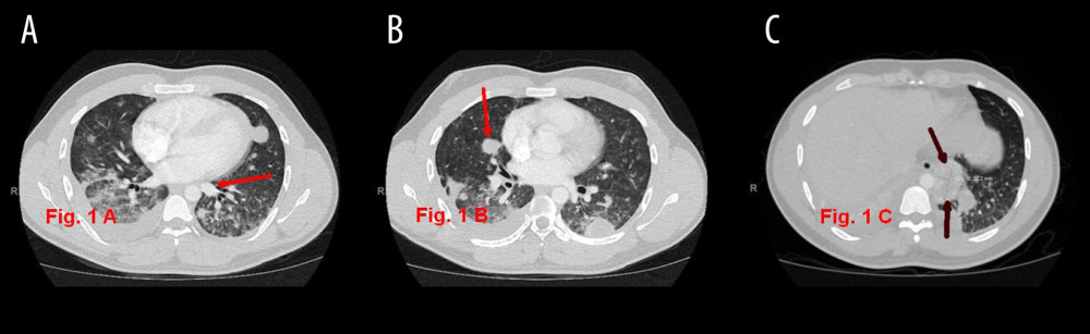 (A–C) Computed tomography (CT) of the chest showing diffuse bilateral pulmonary nodules (red arrow).