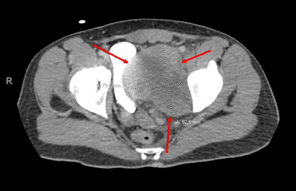 Computed tomography (CT) of the pelvis showing a large heterogeneous soft tissue mass compressing the bladder (red arrow).