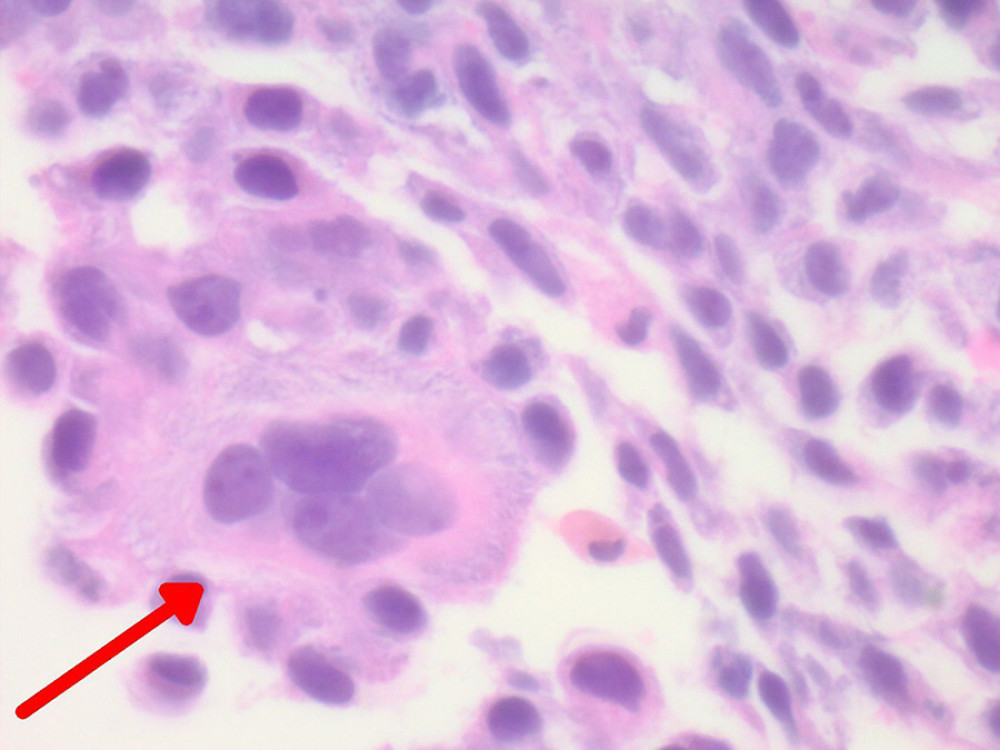 The tumor cells strongly express Cytokeratin AE1/3 (60×).