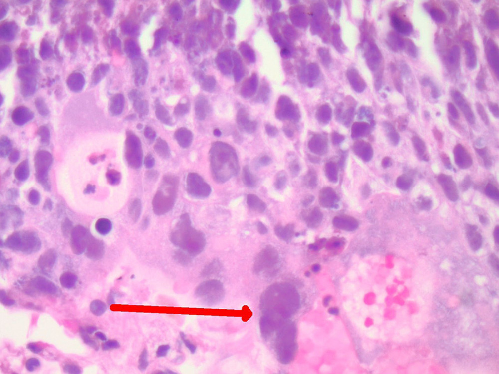 Lung tissue histology illustrates a nest of highly pleomorphic cytotrophoblasts admixed with syncytiotrophoblasts (red arrow), mitotic figures, and necrosis.