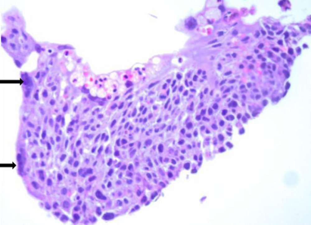 H&E high-power highlights the multinucleated syncytiotrophoblasts (black arrows) and the smaller cells with pale cytoplasm and hyperchromatic nuclei are the intermediate and cytotrophoblasts.